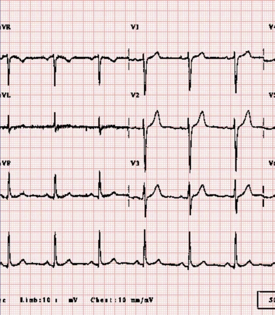 Electrocardiogram